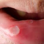Herpetic stomatitis tratament, cauze și simptome la adulți