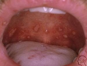 Herpetic stomatitis tratament, cauze și simptome la adulți