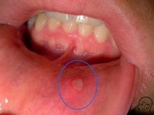 Herpeszes szájgyulladás kezelésére, okai és tünetei felnőtteknél (tünetek) Herpeszes szájgyulladás kezelésére, okai és tünetei felnőtteknél