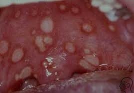 Herpeszes szájgyulladás kezelésére, okai és tünetei felnőtteknél (stomatitis) Herpeszes szájgyulladás kezelésére, okai és tünetei felnőtteknél