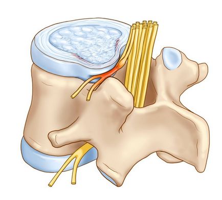 Hirudoterapia cu osteocondroză