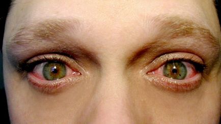 Ochii și tratamentul acarienilor, fotografie