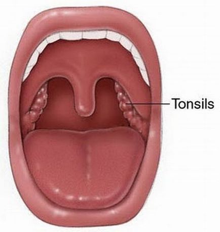 Angina purulentă în tipurile copilului, simptome și trăsături de tratament, copilul este sănătos!