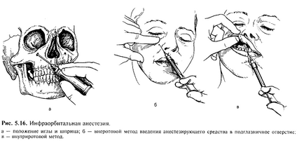 Інфраорбітальна анестезія - хороший стоматологічний портал, хороший стоматологічний портал