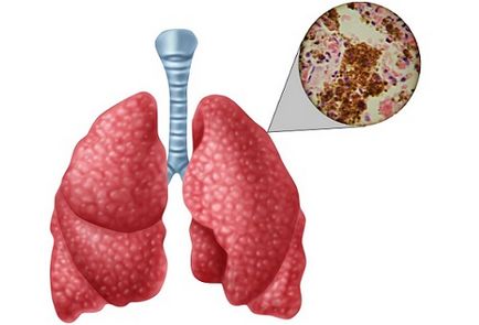 Ce fel de tulburări poate arăta o tomografie computerizată a plămânilor?