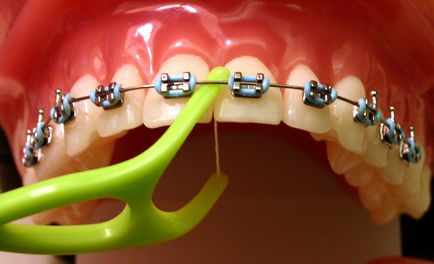 Hogyan kell használni a fogselymet fogszabályozó és hogyan kell kiválasztani, gyönyörű
