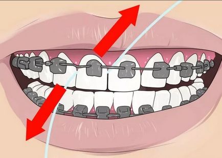 Cum să folosiți ață dentară pentru bretele și ce să alegeți, frumoasă