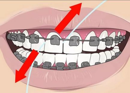 Як користуватися зубною ниткою при брекетах і яку вибрати, красиві