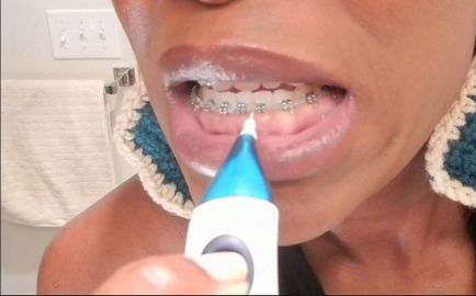 Як користуватися зубною ниткою при брекетах і яку вибрати, красиві