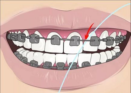 Hogyan kell használni a fogselymet fogszabályozó és hogyan kell kiválasztani, gyönyörű