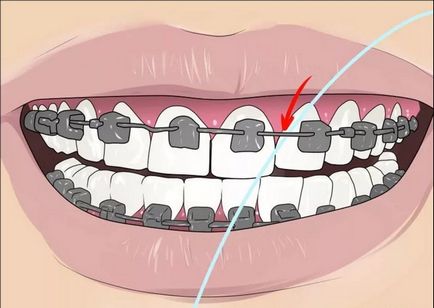 Як користуватися зубною ниткою при брекетах і яку вибрати, красиві