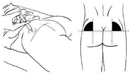 Cum se face o injecție intramusculară în fesă (foto)