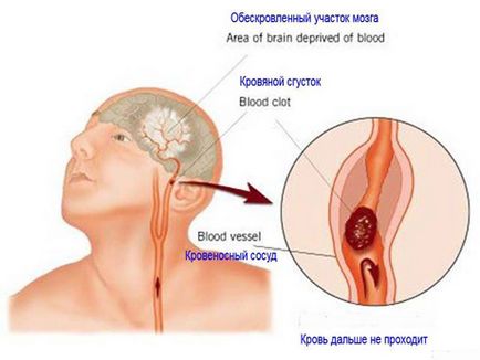 Cum se recunoaște un accident vascular cerebral prin simptomele tipurilor și cauzelor unei boli periculoase