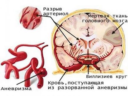 Hogyan lehet felismerni a stroke tüneteinek típusai és okai veszélyes betegségek