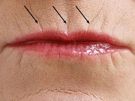 Cum să eliminați ridurile de pe buza superioară și în jurul gurii cu ajutorul injecției, hardware și