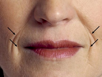 Як прибрати зморшки над верхньою губою і навколо рота за допомогою ін'єкційних, апаратних і
