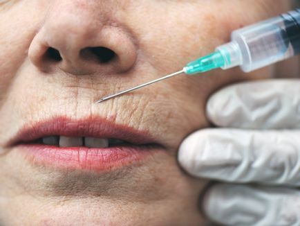 Cum să eliminați ridurile de pe buza superioară și în jurul gurii cu ajutorul injecției, hardware și