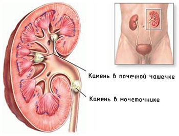 Piatra din ureter