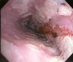 Candidoza esofagului cum se tratează, pilulele și efectele candidozei