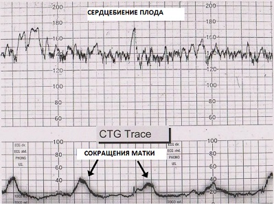 Кардіотокографія (КТГ)