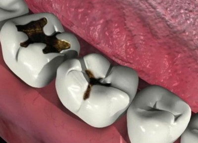 Clasificarea cariilor dentare, cauzele și prevenirea