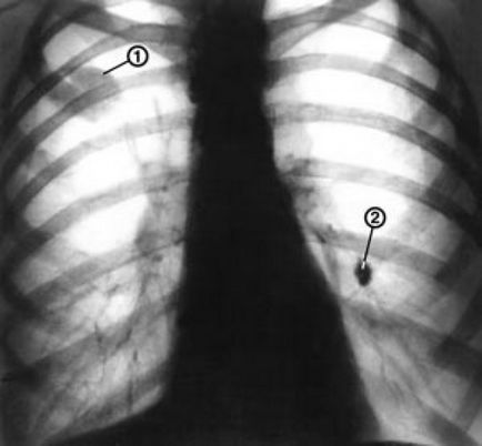 Carcinom pulmonar carcinoid - metode de tratament