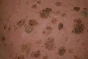Keratoma soiuri de piele de patologie, metode progresive de tratament