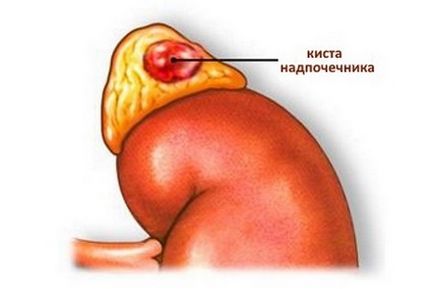 Кіста надниркової причини, симптоми і лікування