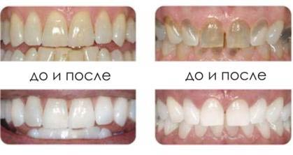 Лазерне відбілювання зубів чарівна посмішка - стоматологія на Таганці