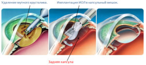 Etapele eliminării cataractei laser, indicații