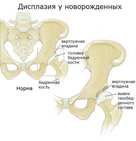 displazitsii kezelés - hálózatának klinikák „Osteomed”