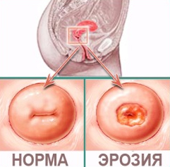 Tratamentul eroziunii colului uterin de către aparatul din prețul chirurgitronului din Moscova