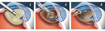 Tratamentul cataractei la nivelul ochiului