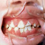 Tratamentul parodontozei cu metode populare - bisturiu - informație medicală-educativă