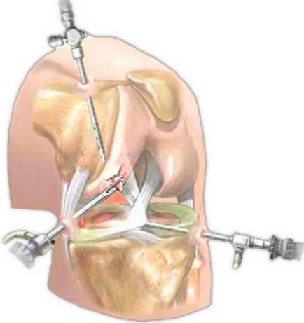 Tratamentul rănirii cornului meniscului medial în clinica Dr. Ochakov