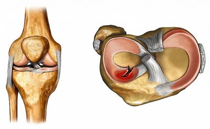 Tratamentul rănirii cornului meniscului medial în clinica Dr. Ochakov