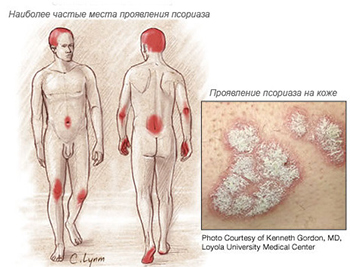 Psoriasis kezelése népi jogorvoslati