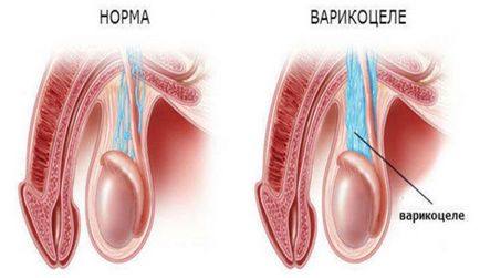 varicocele kezelés műtét nélkül népi jogorvoslati otthon