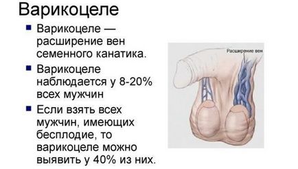 Лікування варикоцеле без операції народними засобами в домашніх умовах