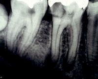 Tratamentul dinților