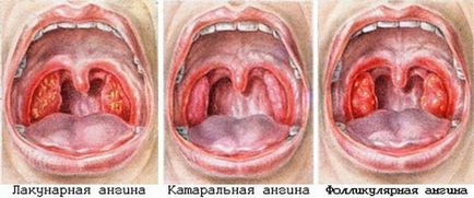 Medicina pentru angină pectorală pentru copii și adulți eficiente antibiotice, cele mai bune remedii populare