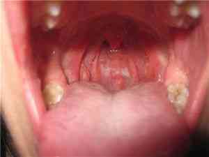Lugol cu ​​faringită atrofică - boala gâtului - catalog de articole - rețete medicinale populare