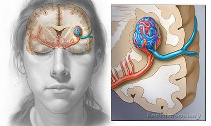 Rendellenességgel agyi erek - tünetek és kezelés