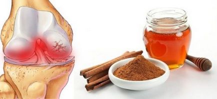 Мед і кориця при артриті - рецепти для лікування