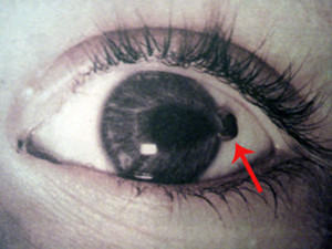 Melanomul coroidului ochiului - descriere, cauze, simptome, tratament