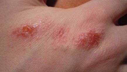 Dermatita umeda