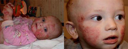 Мокнучий дерматит у немовляти і дорослого лікування, причини