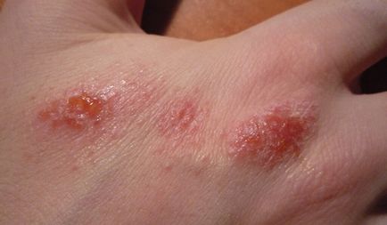 Dermatita umeda la sugari si adulti, tratament, cauze