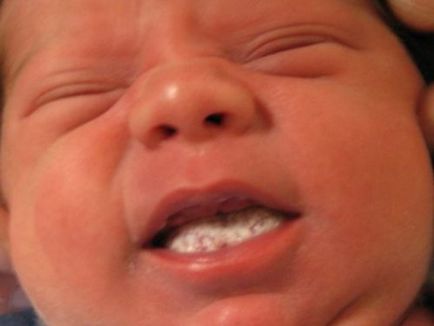 Молочниця на мові у грудничка, лікування кандидозу у новонароджених, причини