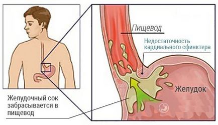 Недостатність кардії шлунка симптоми і лікування